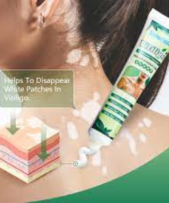 Sumifun New Vitiligo Treatment Ointment Best Product