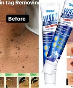 Wart Remover Ointment Cream
